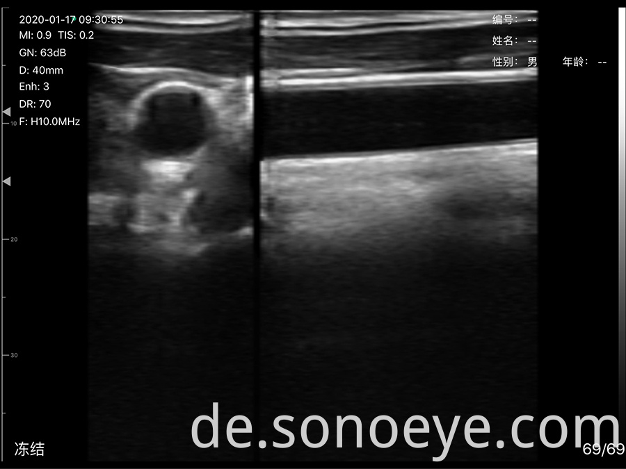 porket ultrasound